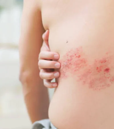 Es muy importante el diagnóstico y tratamiento rápido del herpes zóster o "culebrilla"