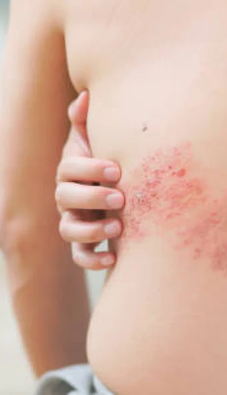 Es muy importante el diagnóstico y tratamiento rápido del herpes zóster o "culebrilla"