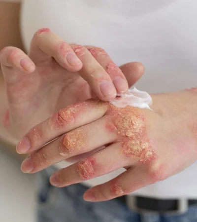 Se trata de una enfermedad de origen inmunológico, inflamatoria, crónica y sistémica, que se manifiesta en la piel.