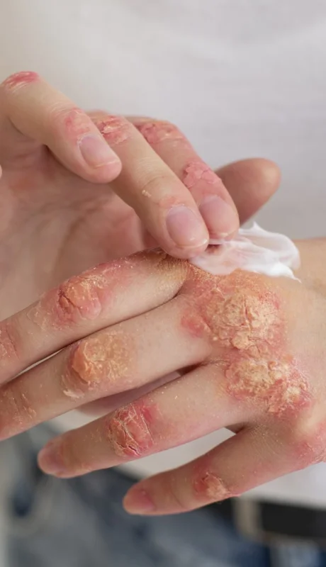 Se trata de una enfermedad de origen inmunológico, inflamatoria, crónica y sistémica, que se manifiesta en la piel.