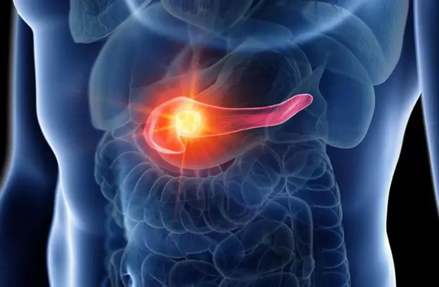El cáncer de páncreas es conocido por su extrema agresividad y por ser uno de los más difíciles de tratar: pocos sobreviven más de 5 años.