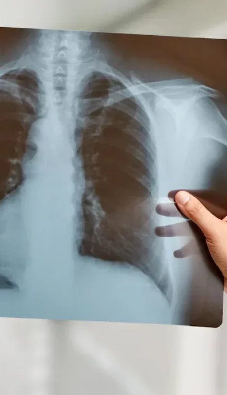 Un hombre sobrevivió 48 horas sin pulmones