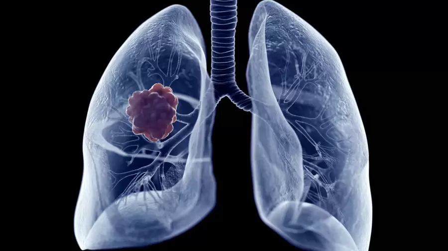 El cáncer de pulmón es una consecuencia de la contaminación y el tabaco